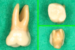 歯根分割抜去法（分割抜歯）について教えてください。 静岡市葵区の歯医者 みまつ渡辺歯科医院｜静岡の総合歯科です。