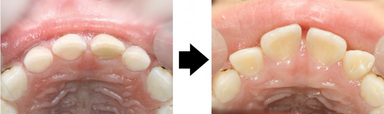 3997 】 女児:下顎中切歯が先天欠如(経過観察)・右上側切歯に切歯結節 静岡市葵区の歯医者 みまつ渡辺歯科医院|静岡の総合歯科です。