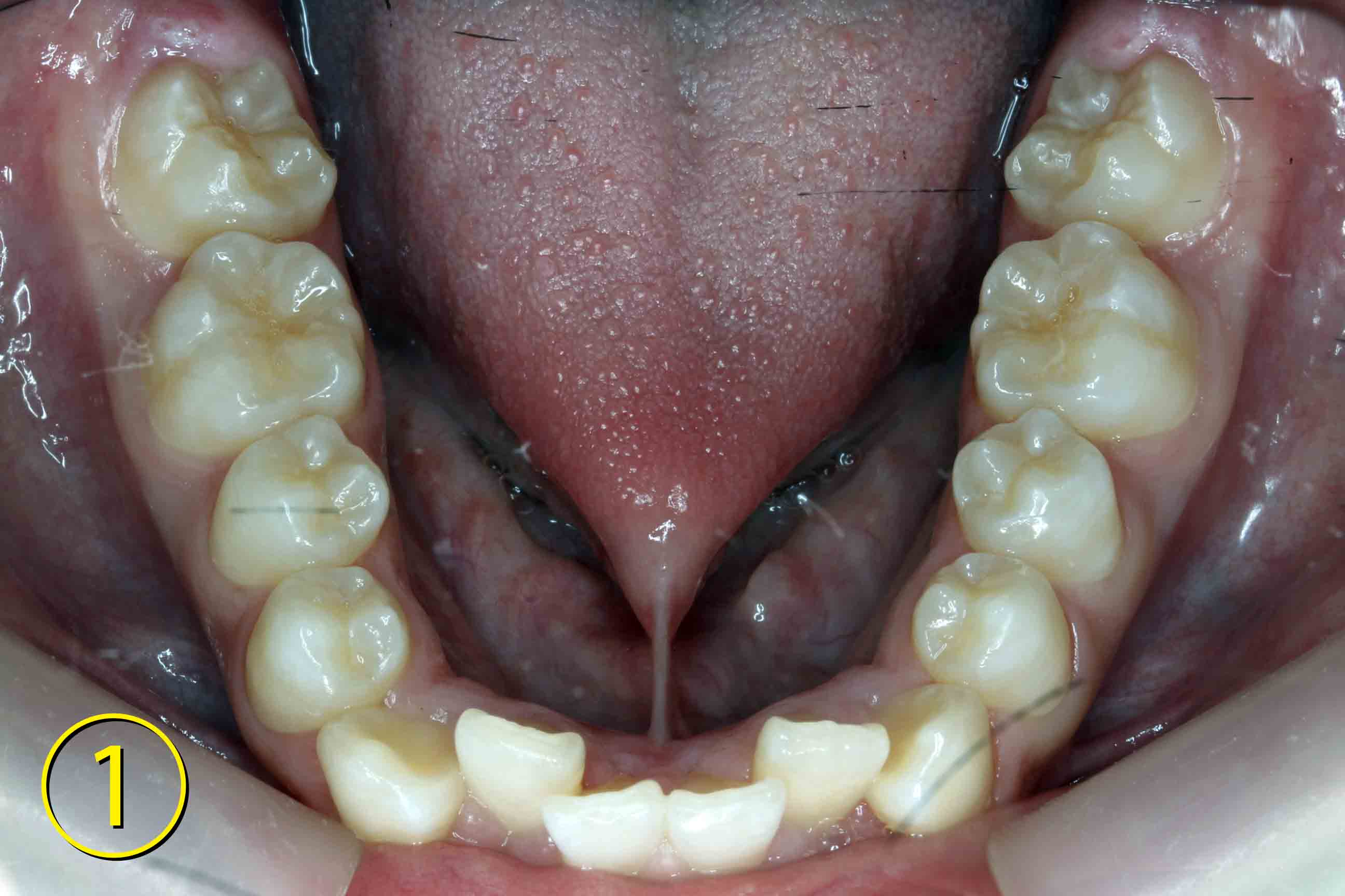 小学生　舌 3474 】 15歳 男性：舌小帯短縮症（舌小帯切除） | 静岡市葵区の歯医者 みまつ渡辺歯科医院｜静岡の総合歯科です。