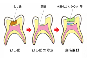 覆髄について教えてください。 | 静岡市葵区の歯医者 みまつ渡辺歯科医院｜静岡の総合歯科です。