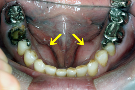 口の中 骨隆起 上口蓋 治療