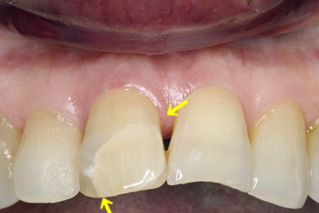 歯 の ひび割れ 症状