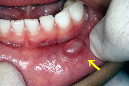 喉の粘液を取り除くにはどうすればよいですか?